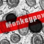 Monkeypox: Understanding, Prevention, and Treatment